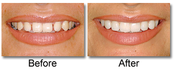 Porcelain Veneers before and after with Dr. Lisa Mandeville Family Dentistry