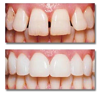 Before after image of tooth bonding and filling with mandeville general family dentist Dr. Lisa