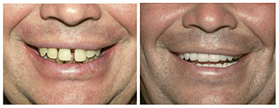 Image of full dentures before and after, Dr. Lisa Landesman Dentistry