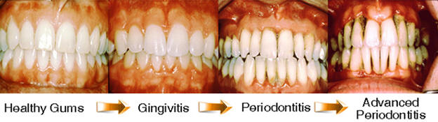 Visual Image of gum deterioration 